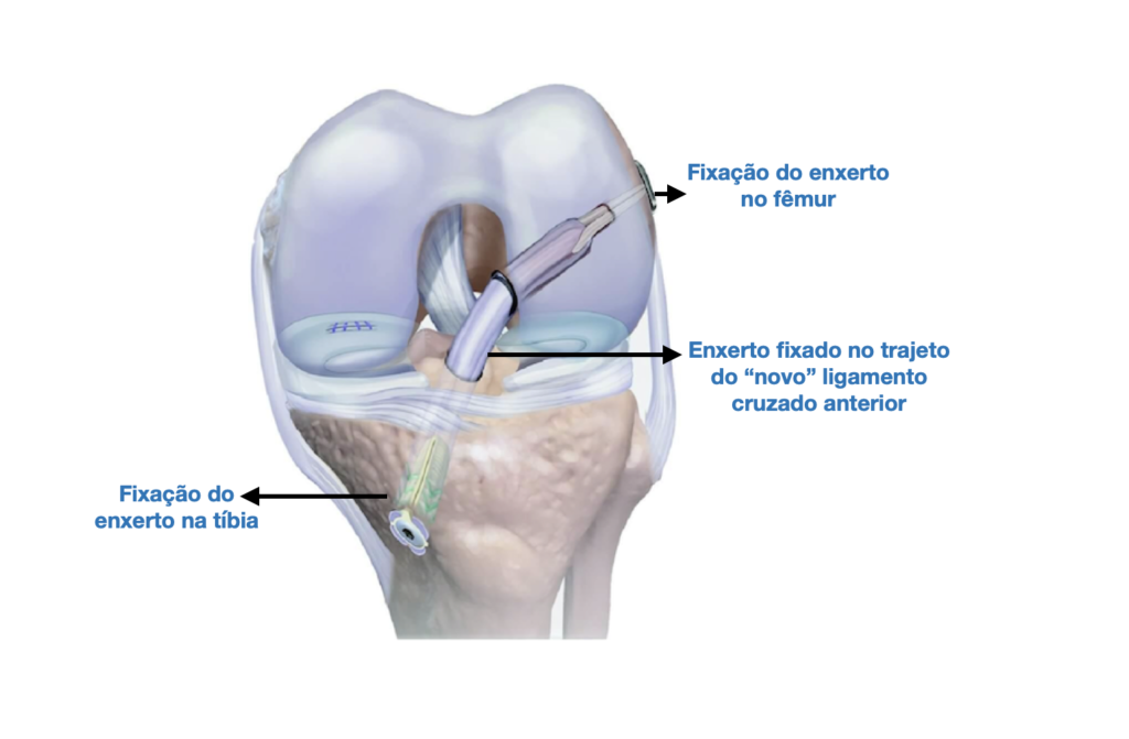 Lesão do ligamento cruzado anterior Ortopedia Galvão