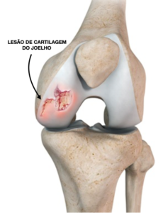 Cartilagem – Ortopedia Galvão