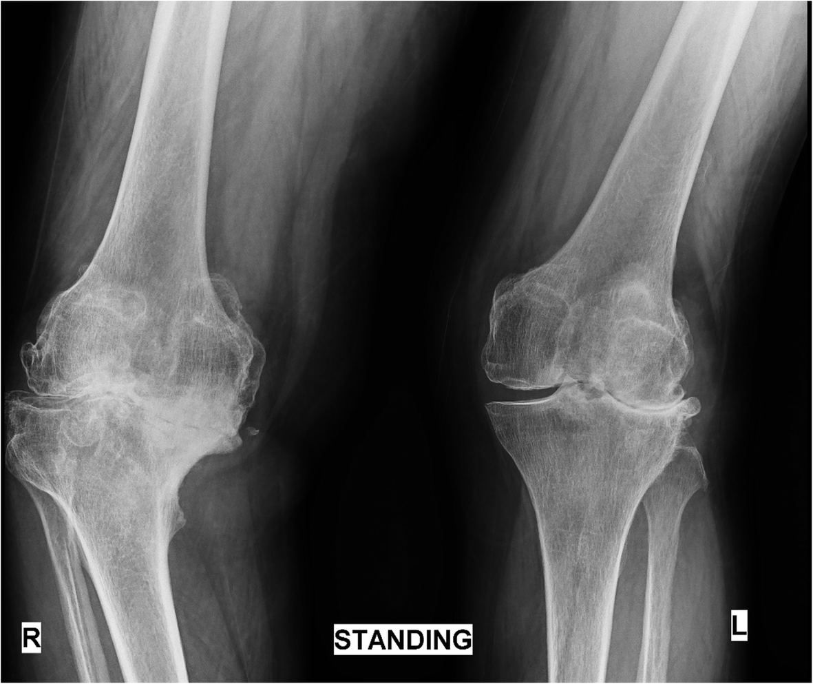 Artrose no joelho Ortopedia Galvão
